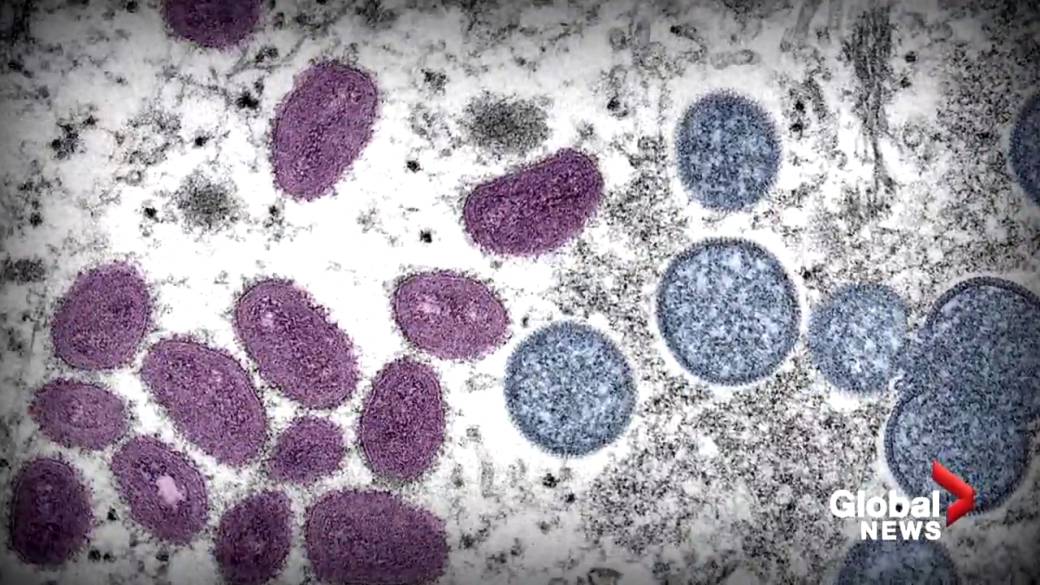 Click here to play the video: 'Doctors fear upcoming events could cause spike in monkeypox cases'