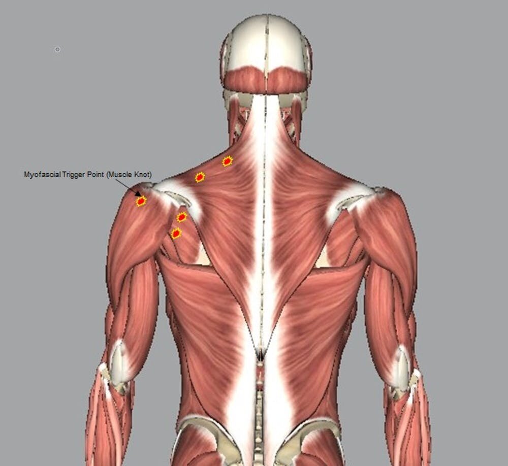 What are muscle knots?  An exercise physiologist explains what those tight little lumps are and how to get rid of them