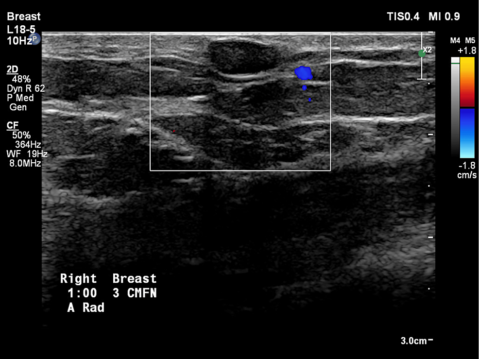 Doppler-ultrasound-image-of-oil-cysts-in-the-right-breast-of-patients-with-a-circumscribed-cyst-at-the-1-o'clock-position,-3-cm-from-the-nipple.