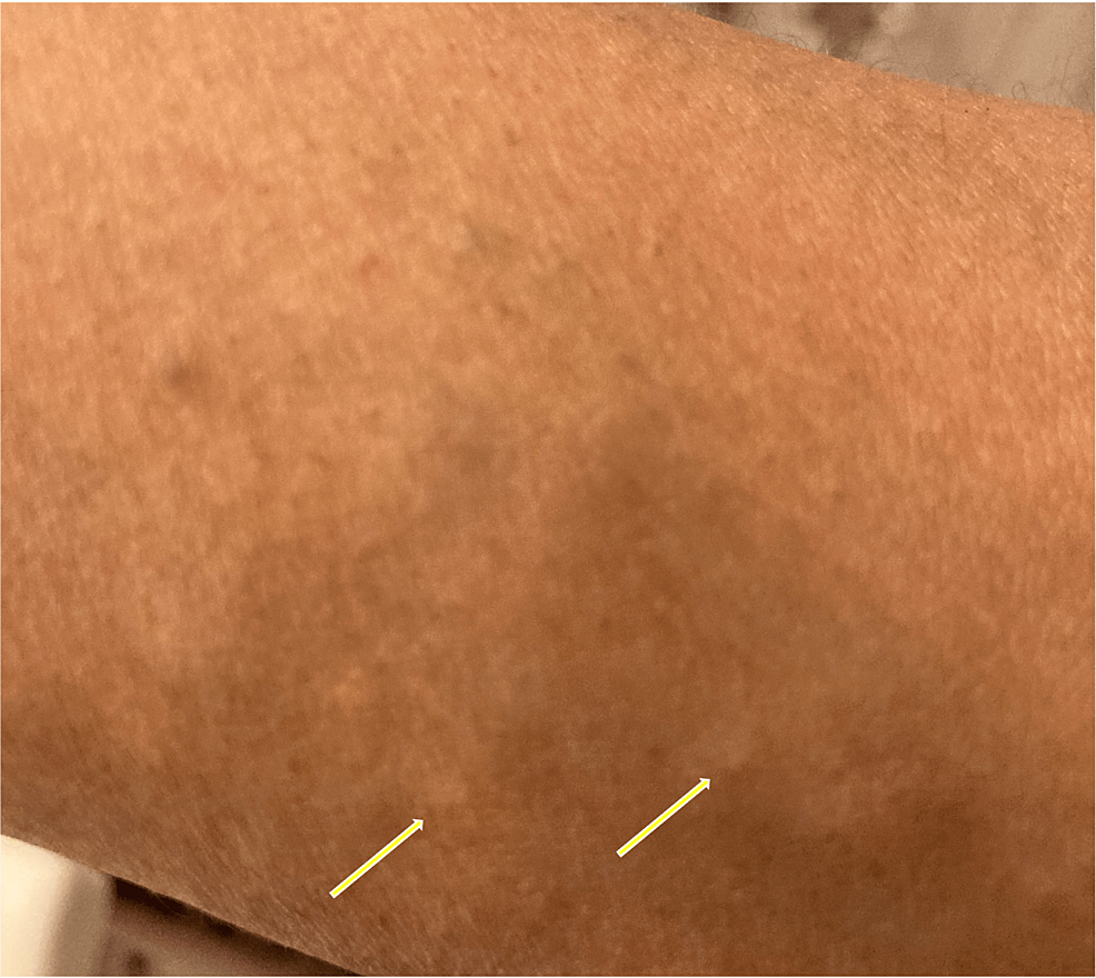 Multiple-small-subcutaneous-cysts-are-located-on-the-patient's-internal-forearm-(arrows).-The-patient's-symptoms-also-extend-to-her-chest-and-the -Hull-out- (not shown).