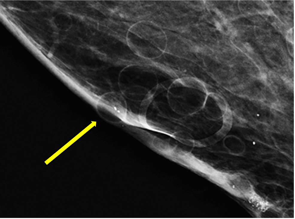 Magnified craniocaudal view of the patient's right breast in mammography.  Multiple subcutaneous cysts are visualized (arrow).