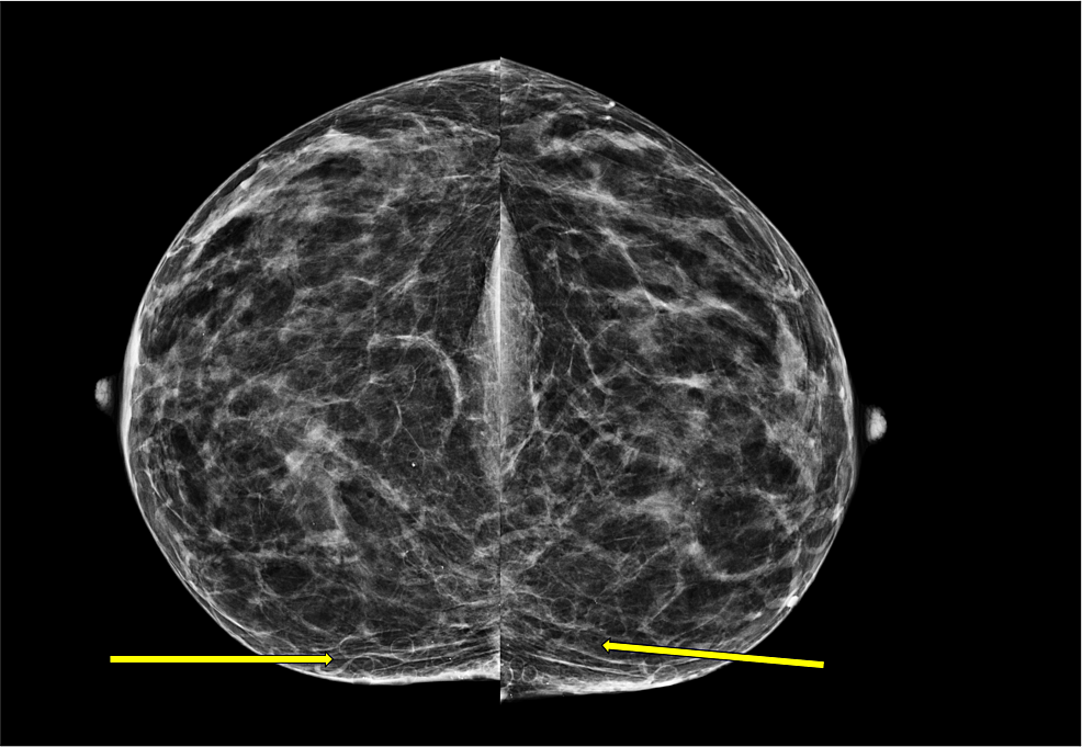 This-craniocaudal-mammographic-image-shows-multiple-benign-oil-cysts-within-the-patient’s-breasts-bilaterally-consistent-with-a-diagnosis-of-steatocystoma-multiplex-(arrows).