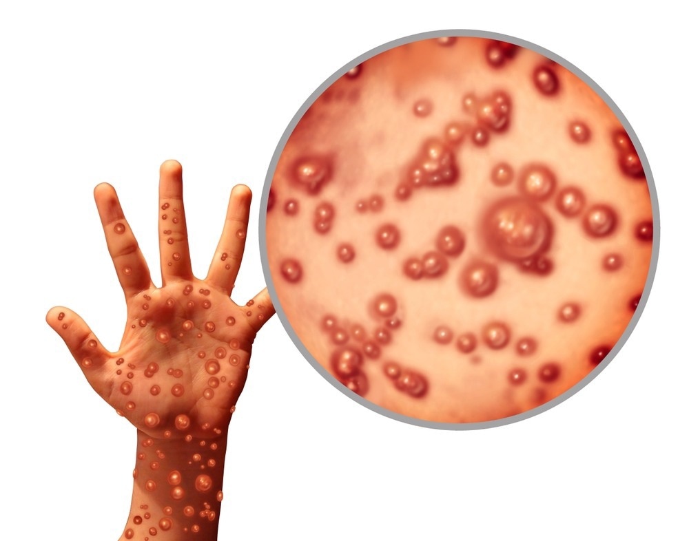 Study: Clinical Features and Novel Presentations of Human Monkeypox in A Central London Centre During The 2022 Outbreak: Descriptive Case Series. Image Credit: Lightspring / Shutterstock.com