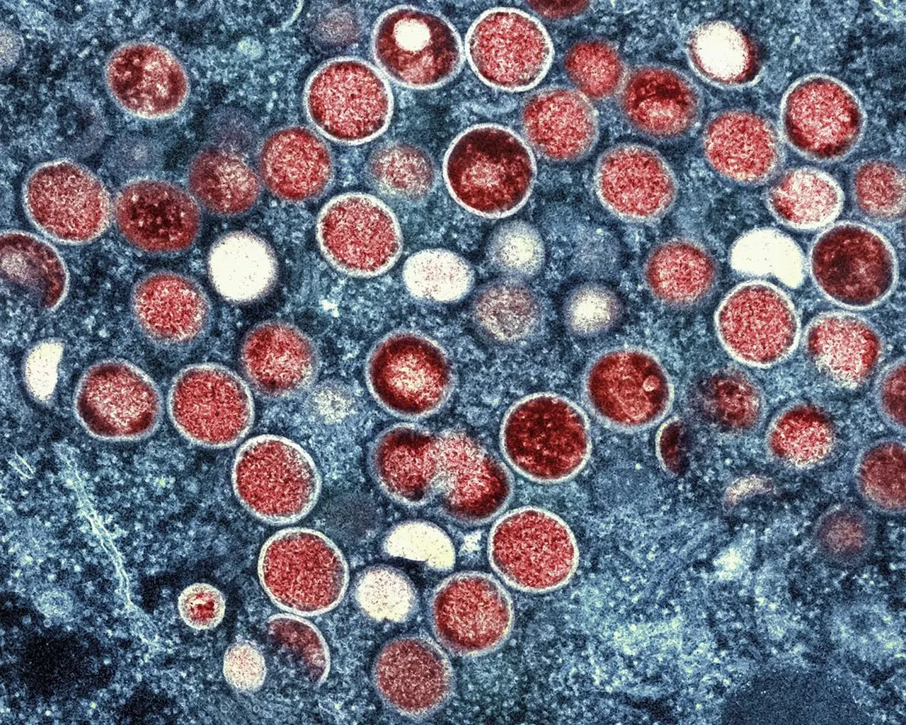 UK: 'Early signs' monkeypox outbreak may be peaking