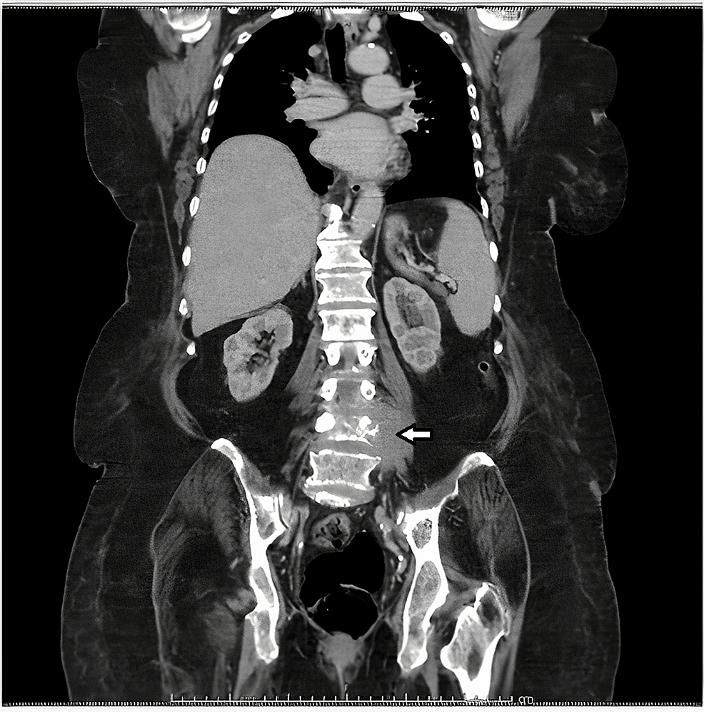 Thoraco-abdominal-pelvic computed tomography scan.