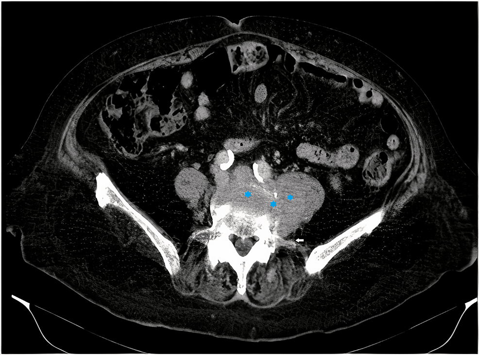 Computed-tomography-scan-of-the-lumbar-spine.