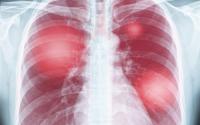 40% of COVID pneumonia patients still had lung problems after 1 year