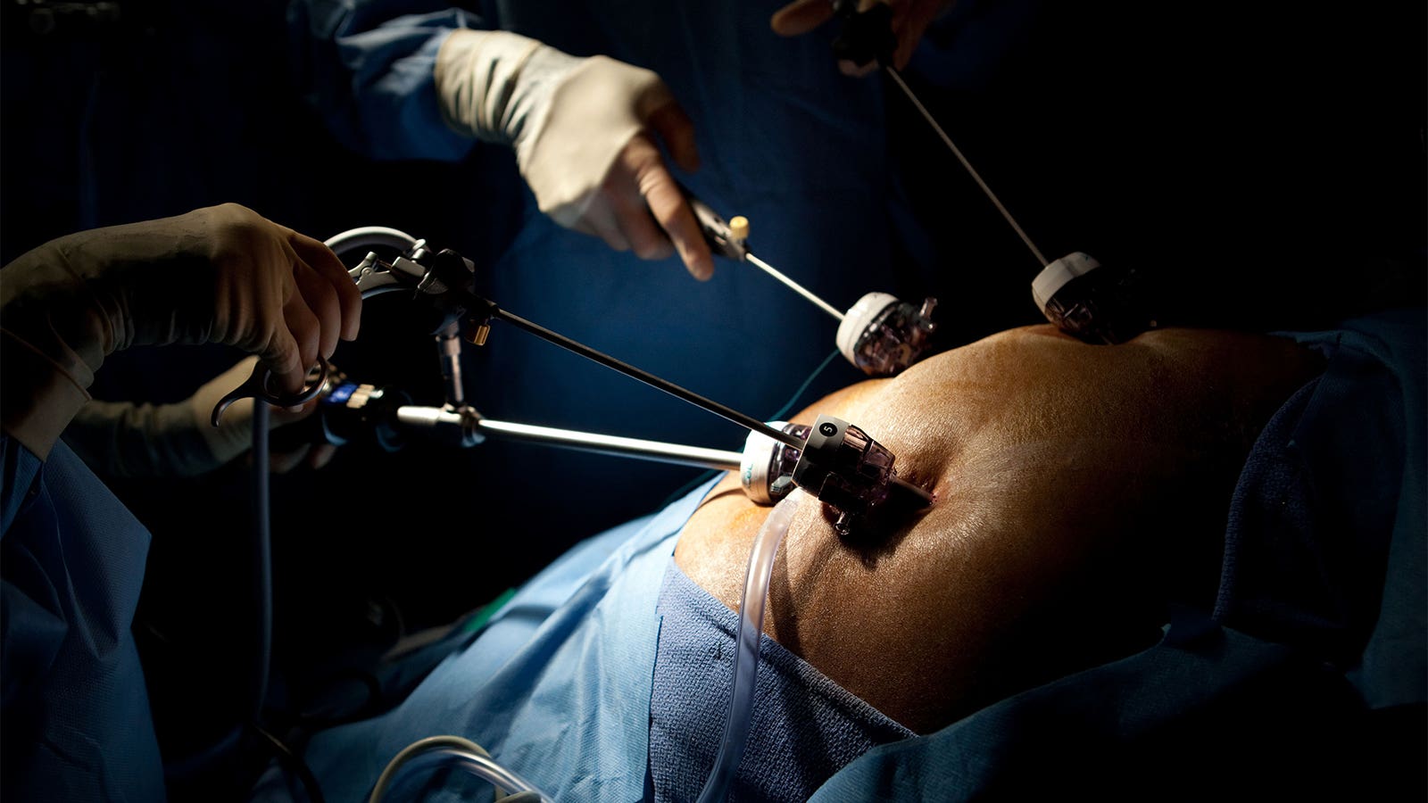 A photo of surgeons performing laparoscopic gastric bypass surgery.