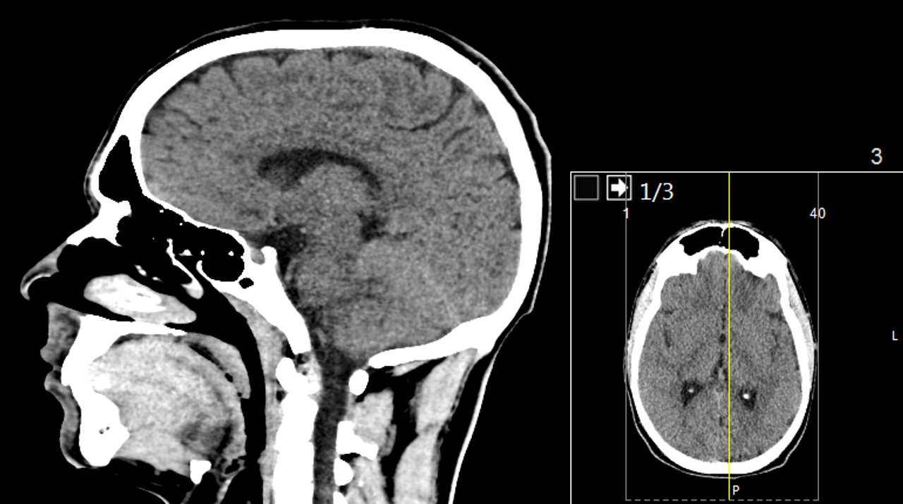 COVID-19 infection significantly increases the risk of neurological disease