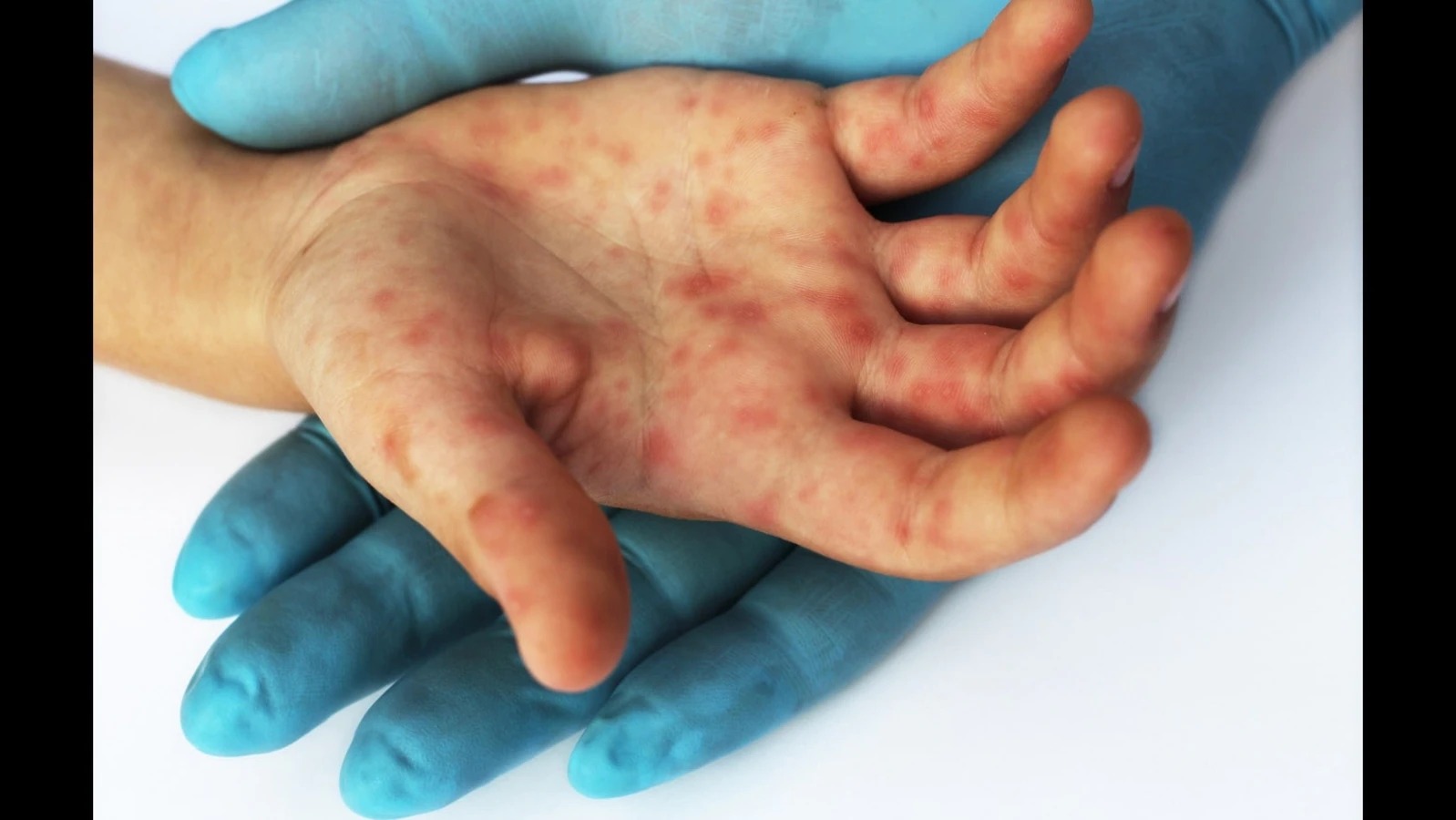 Hand, Foot, and Mouth Disease in Children: Look Out for These Symptoms;  Dos and don'ts for parents