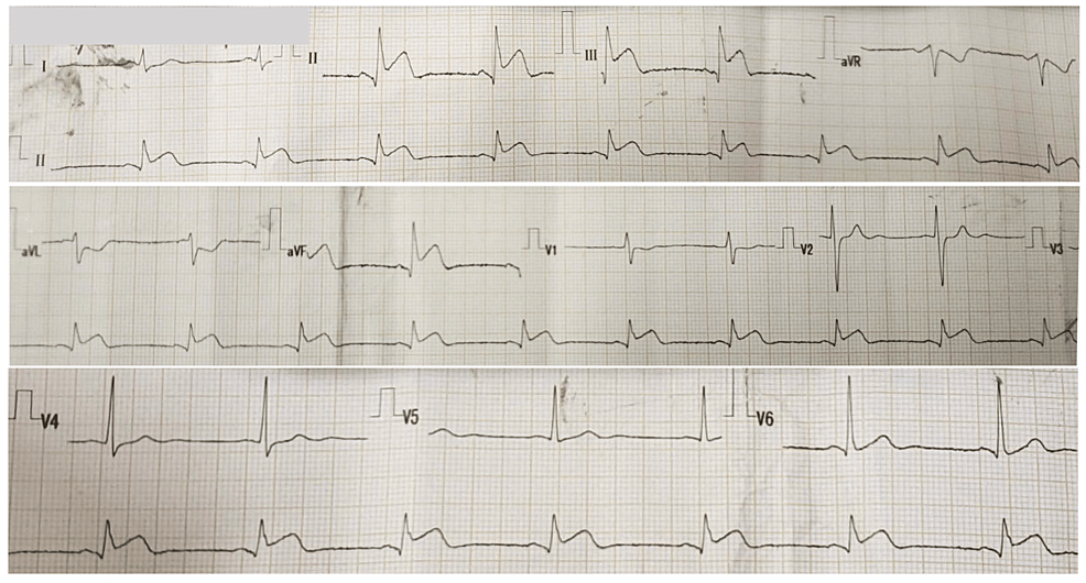 Initial-electrocardiogram.