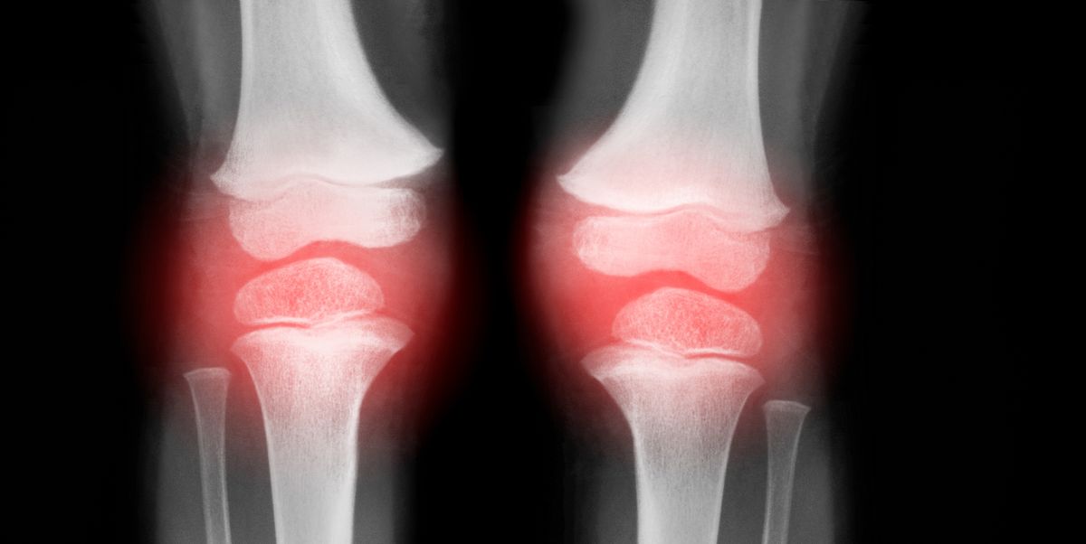 Swollen, sore knees?  These are telltale symptoms of knee arthritis