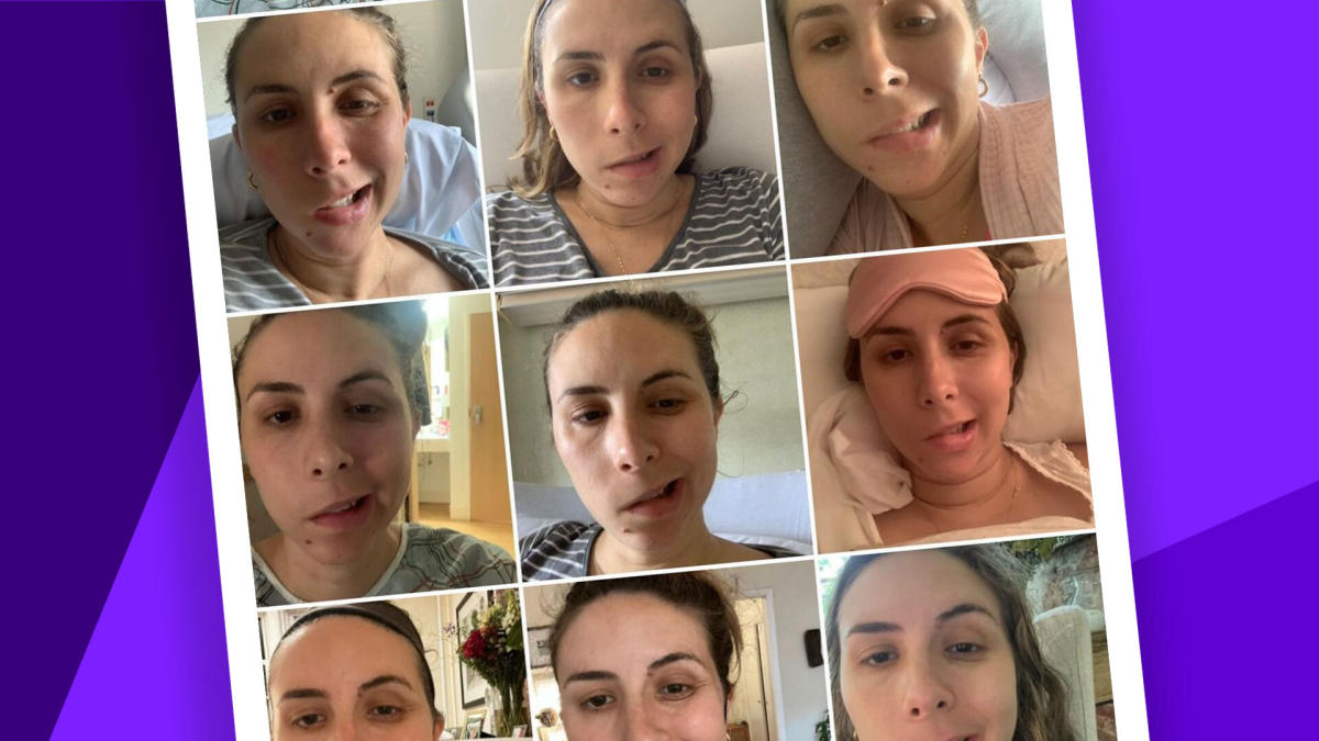 Women Share What It's Like to Have Facial Paralysis From Bell's Palsy: 'That's Not My Face'