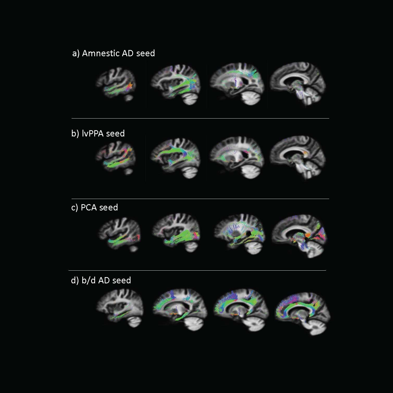 A telltale protein spreads throughout the brain in different patterns based on the patient's Alzheimer's phenotype