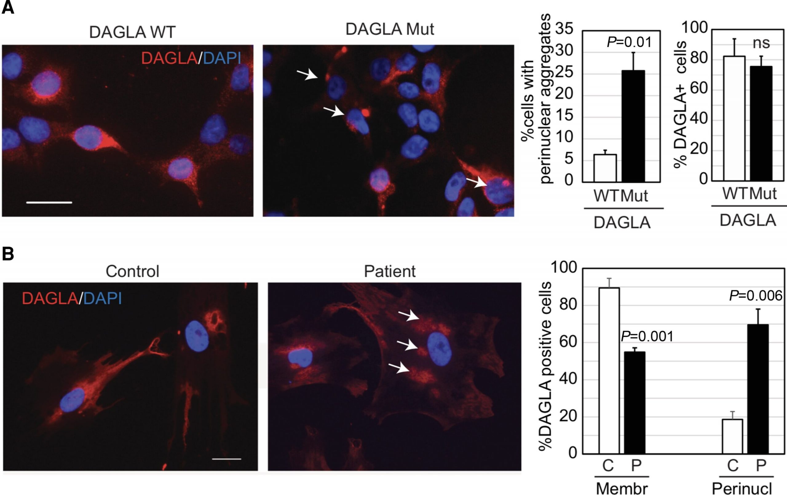 Discovery of an endocannabinoid gene mutation leads to the identification of a new, rare pediatric neurological disorder