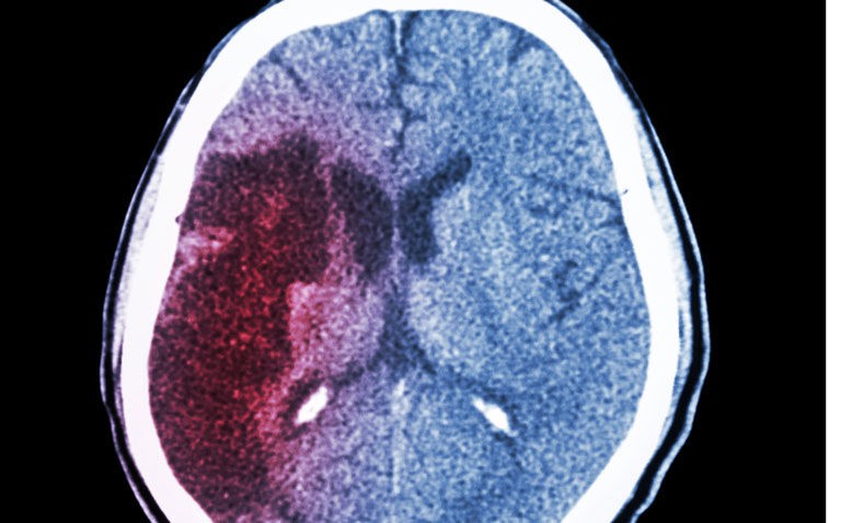 ASPECTS supports decision-making for endovascular therapy in acute ischemic stroke