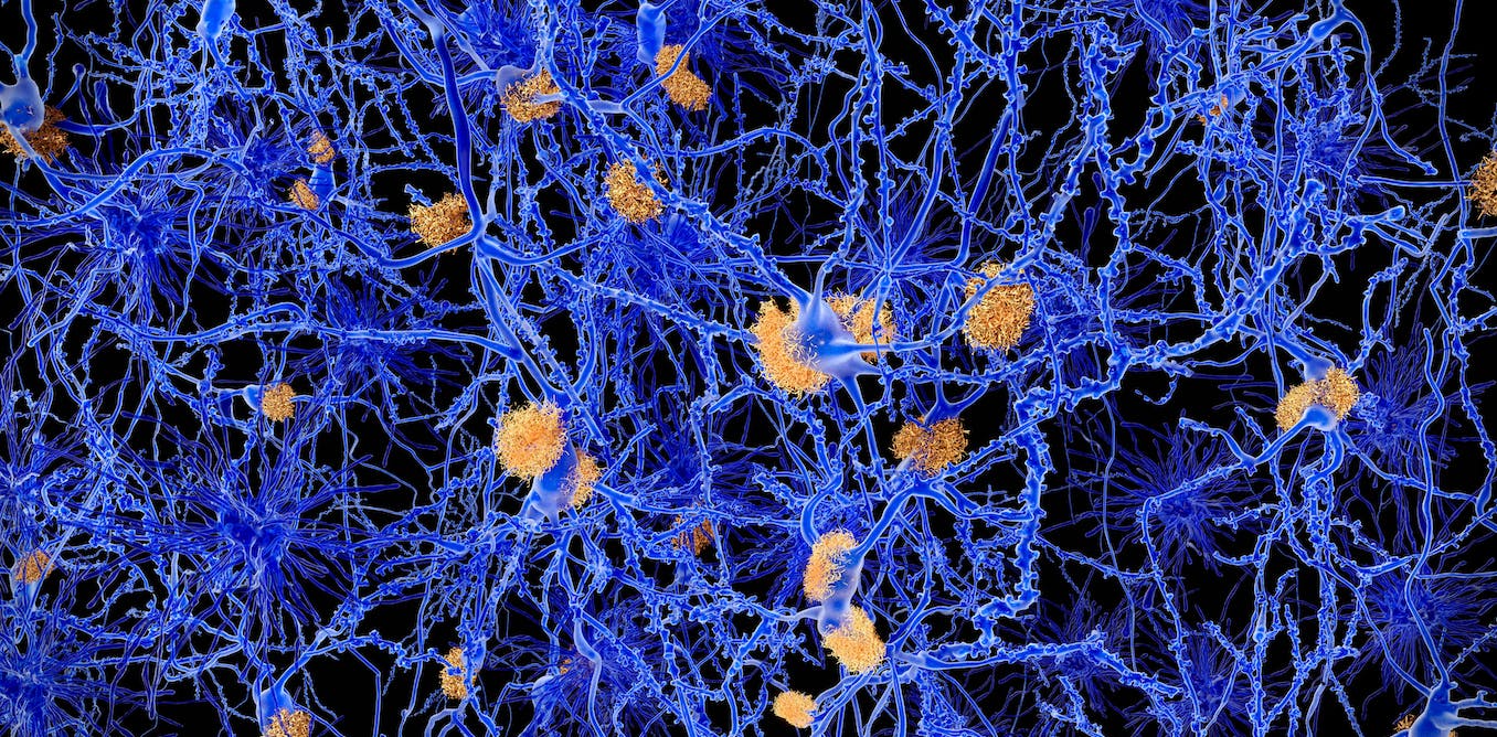 Alzheimer's disease: Surprising new theory about what might be causing it