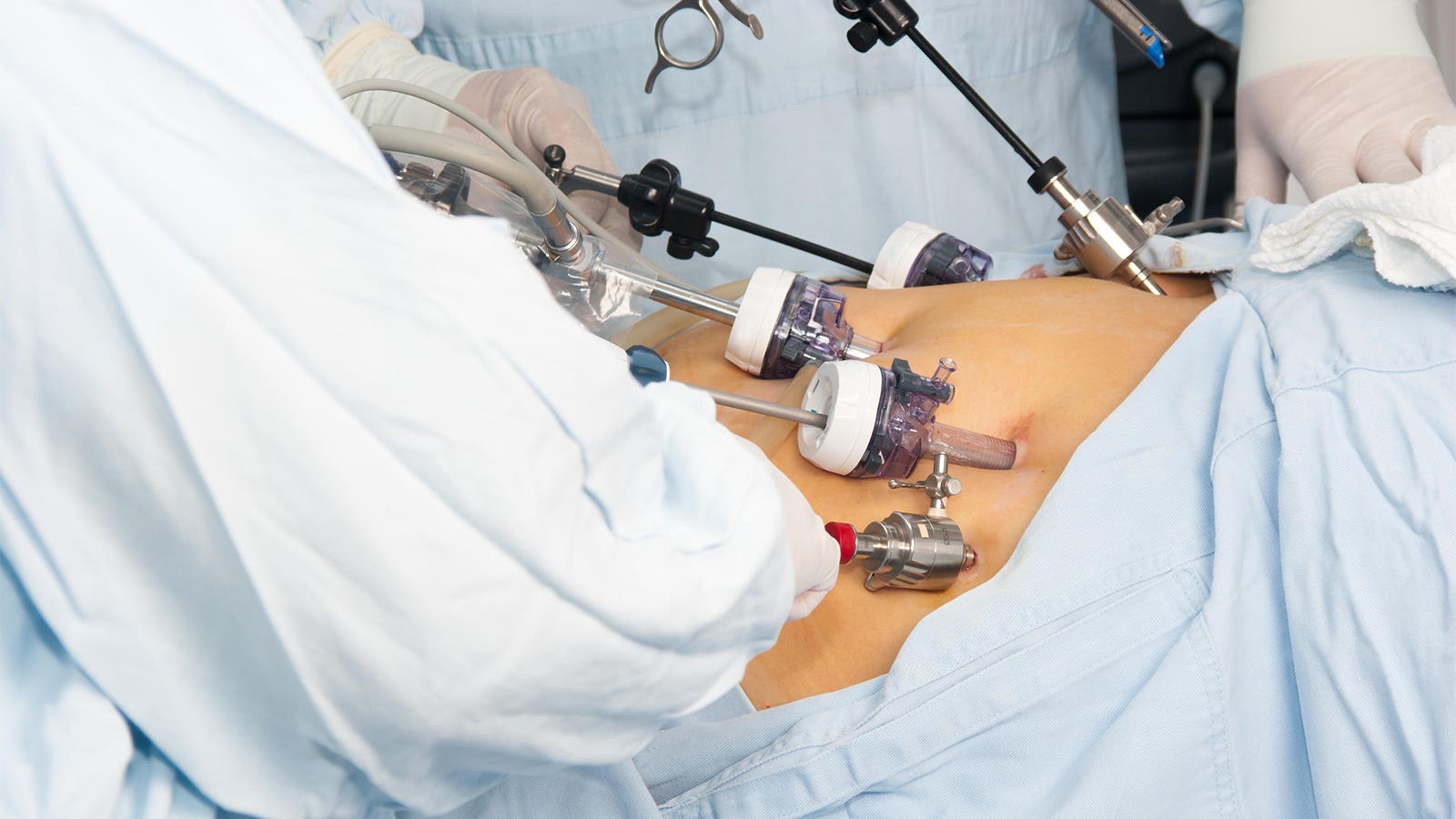 A photo of surgeons performing gastric bypass laparoscopic surgery