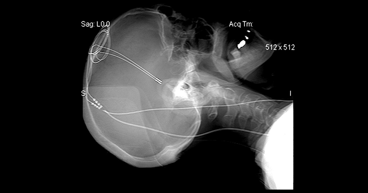 Finding the Treatment for Binge Eating and Addiction with Brain Zaps