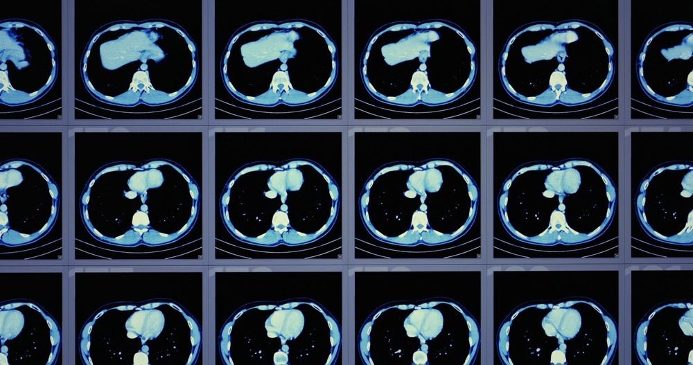 Hybrid imaging system with CT and photon counting for high-resolution imaging