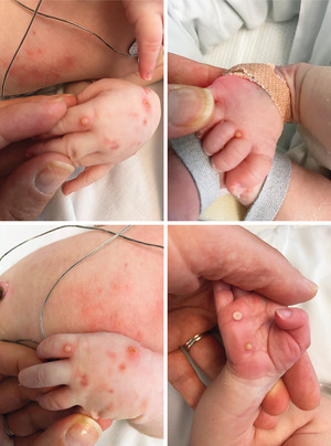 Monkeypox Virus Infection in Newborns |  NEJM