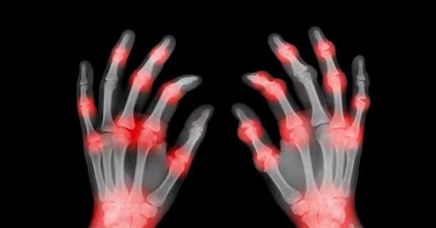 Newly discovered bacterial species in the microbiome could be responsible for rheumatoid arthritis