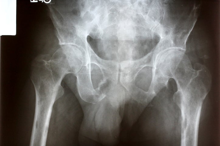 Radiation therapy for high-risk asymptomatic bone metastases can prevent pain and prolong life