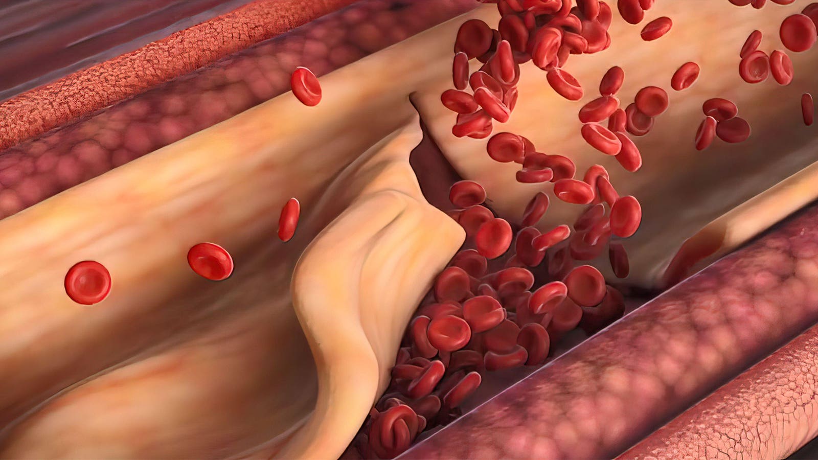 A computer rendering of coronary artery dissection