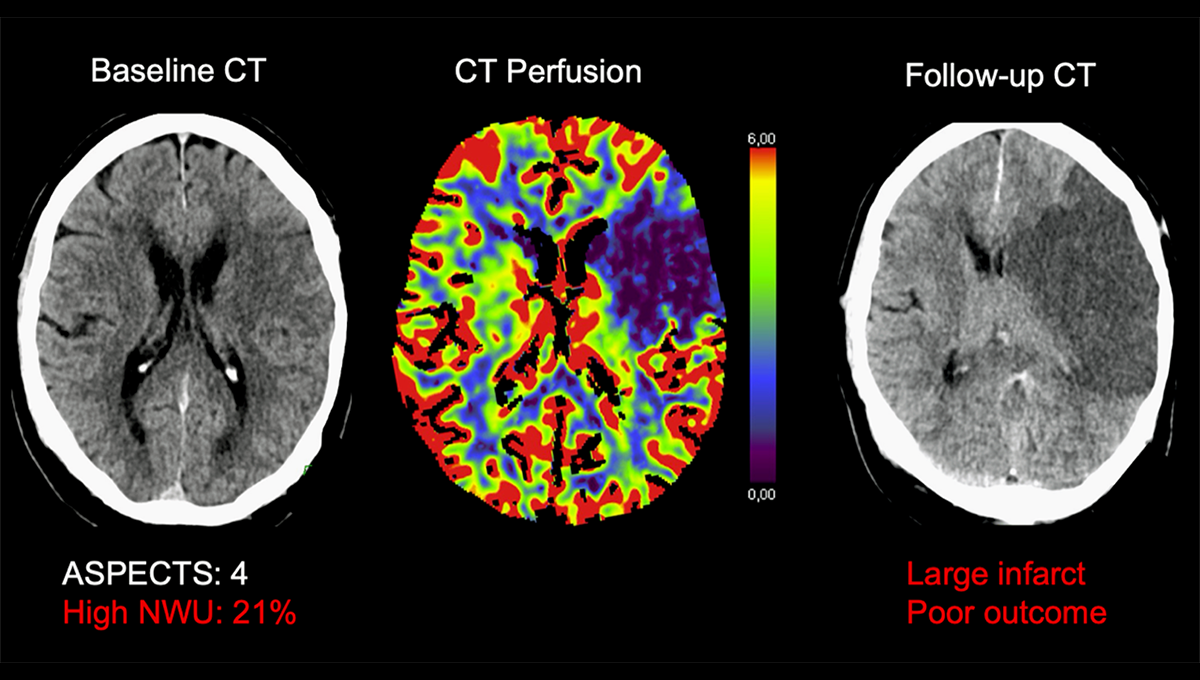 Stroke thrombectomy may work for large infarcts in the late window